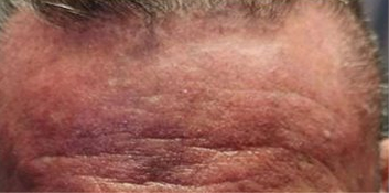 Real patient photo showing a dermatomyositis rash on the forehead before taking LISRAYA