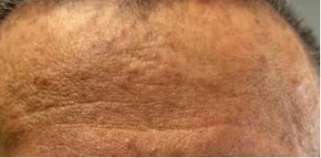 Real patient photo showing the same area of the forehead after one year of treatment with LISRAYA