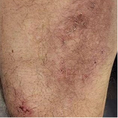 Real patient photo showing scattered dermatomyositis skin marks before taking LISRAYA