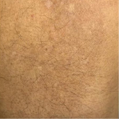 Real patient photo showing the same area of scattered skin marks after one year of treatment with LISRAYA