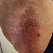 Real patient photo showing a violet-red dermatomyositis rash on the skin before taking LISRAYA