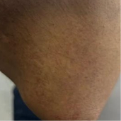 Real patient photo showing the same area of skin after one year of treatment with LISRAYA